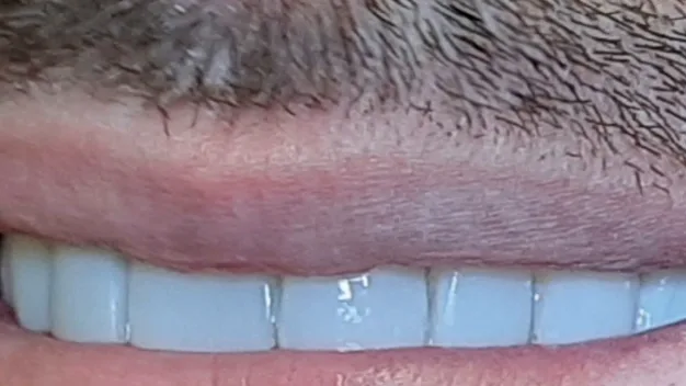 Case 03, after treatment