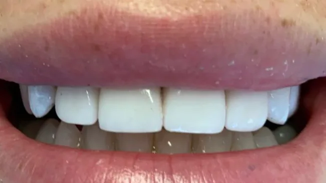 Case 04, after treatment