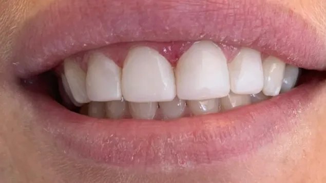 Case 06, after treatment