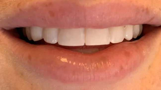 Case 07, after treatment