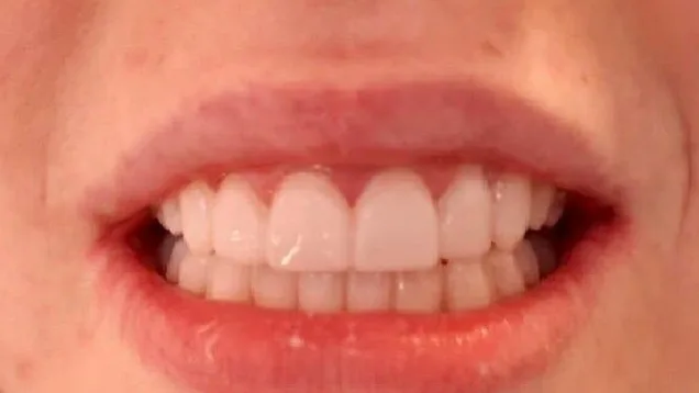 Case 11, after treatment