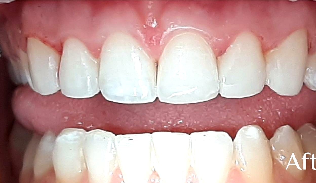 Composite Bonding Explained: What It Is and What to Expect